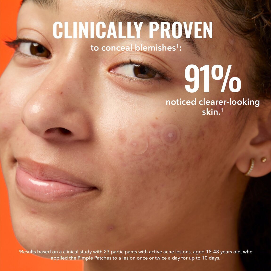 pimple-patches-s3 zb_p.jpg