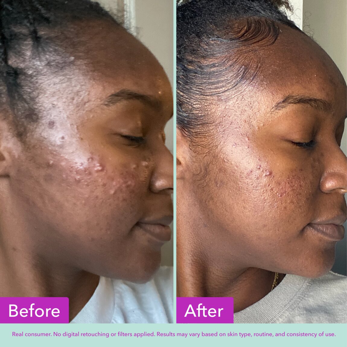acne-foaming-cleanser-k1 zb_p.jpg